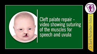 Cleft Palate Repair - Video Showing Suturing Of The Muscles For Speech And Uvula By Dr Richardson