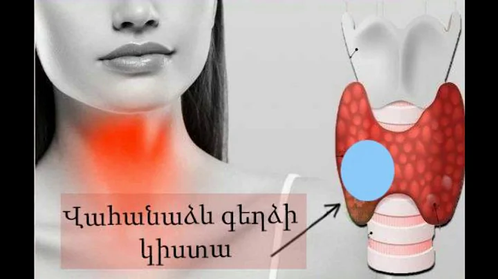 10 նախանշան, որոնք խոսում են վահանաձև գեղձի խնդիրների մասին ⁄Ինչպես լրացնել յոդի պակասը օրգանիզմում