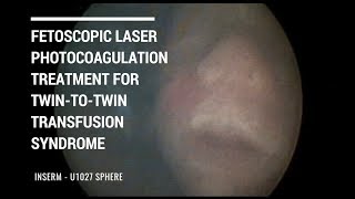 Fetoscopic Laser Photocoagulation Treatment For Twin To Twin Transfusion Syndrome Youtube
