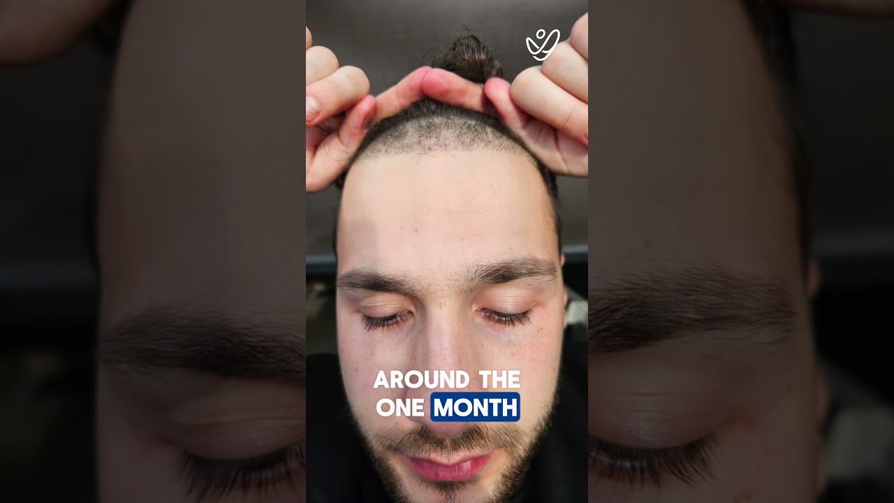 9 months after his hair transplant in Turkey