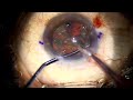 Live Femto-Assisted Cataract Surgery with Eyhance Toric IOL – Dr. Gaurav Luthra