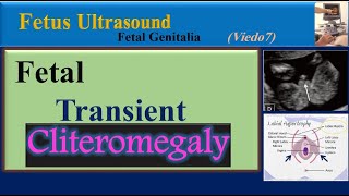 Fetus Ultrasound, Fetal Transient Cliteromegaly