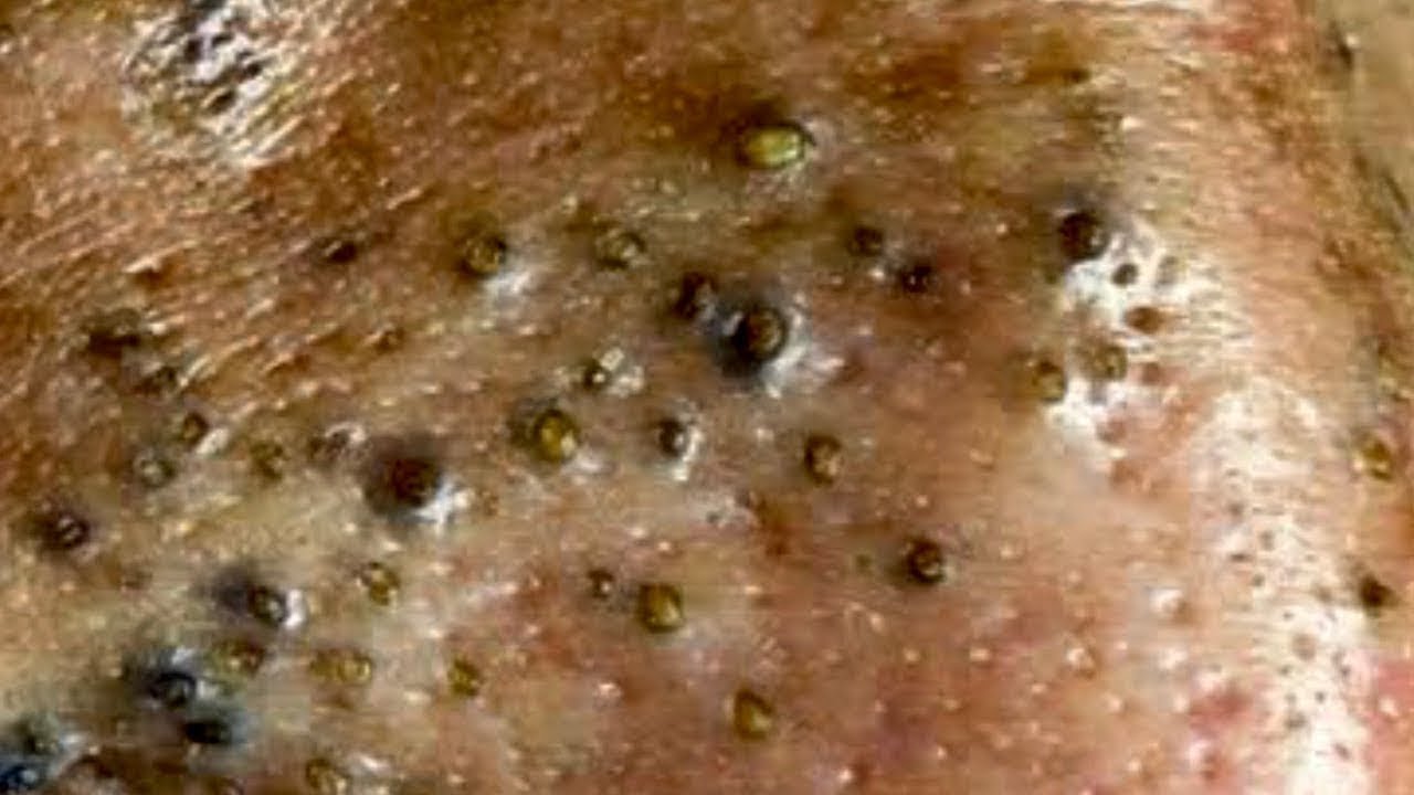 Ga Spa Videos For Removal Of Blackheads