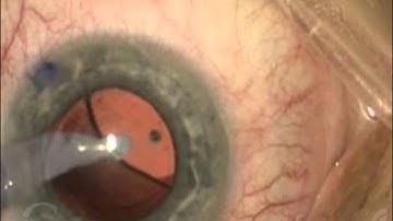 DMEK Triple Procedure