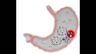 Emphysematous Gastritis_Case Vignette (Dr Pradeep Rangappa)