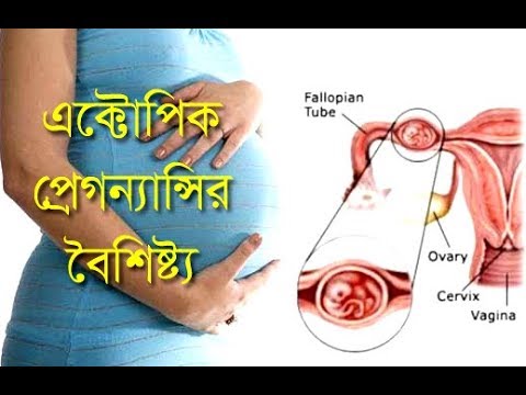 ভিডিও: একটি গর্ভাবস্থা পরীক্ষা একটি Ectopic প্রদর্শিত হবে