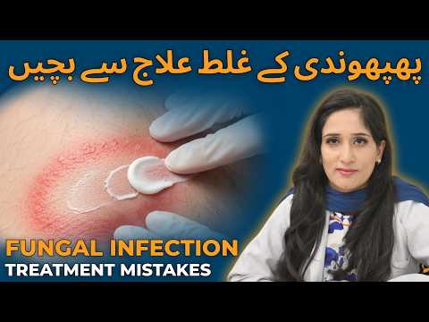 Fungal Infection Kya Hai? - Tinea Symptoms, Types and Treatment - Ringworm (Chambal) Ka Ilaj thumbnail image