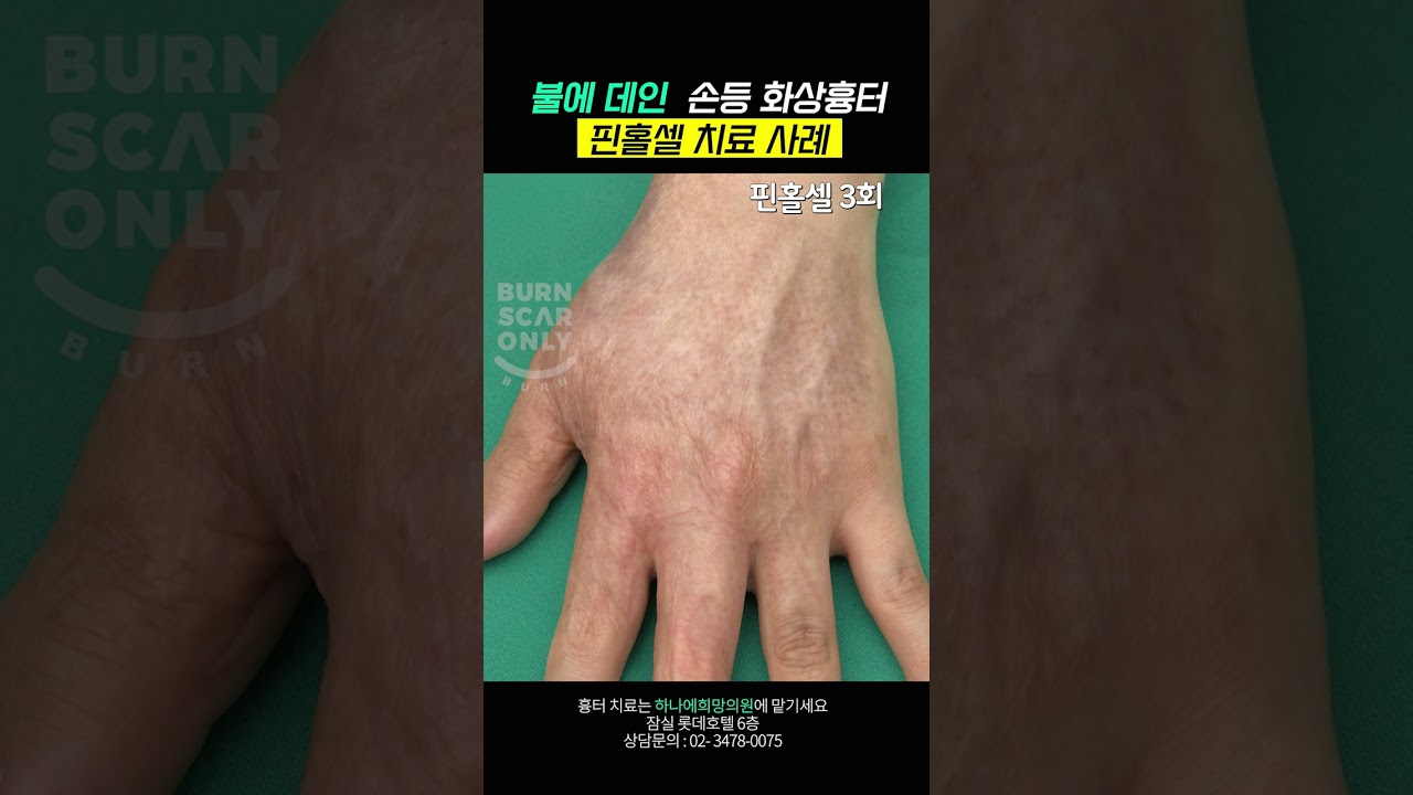 불에 데인 손등 화상흉터 핀홀셀 치료 사례!????