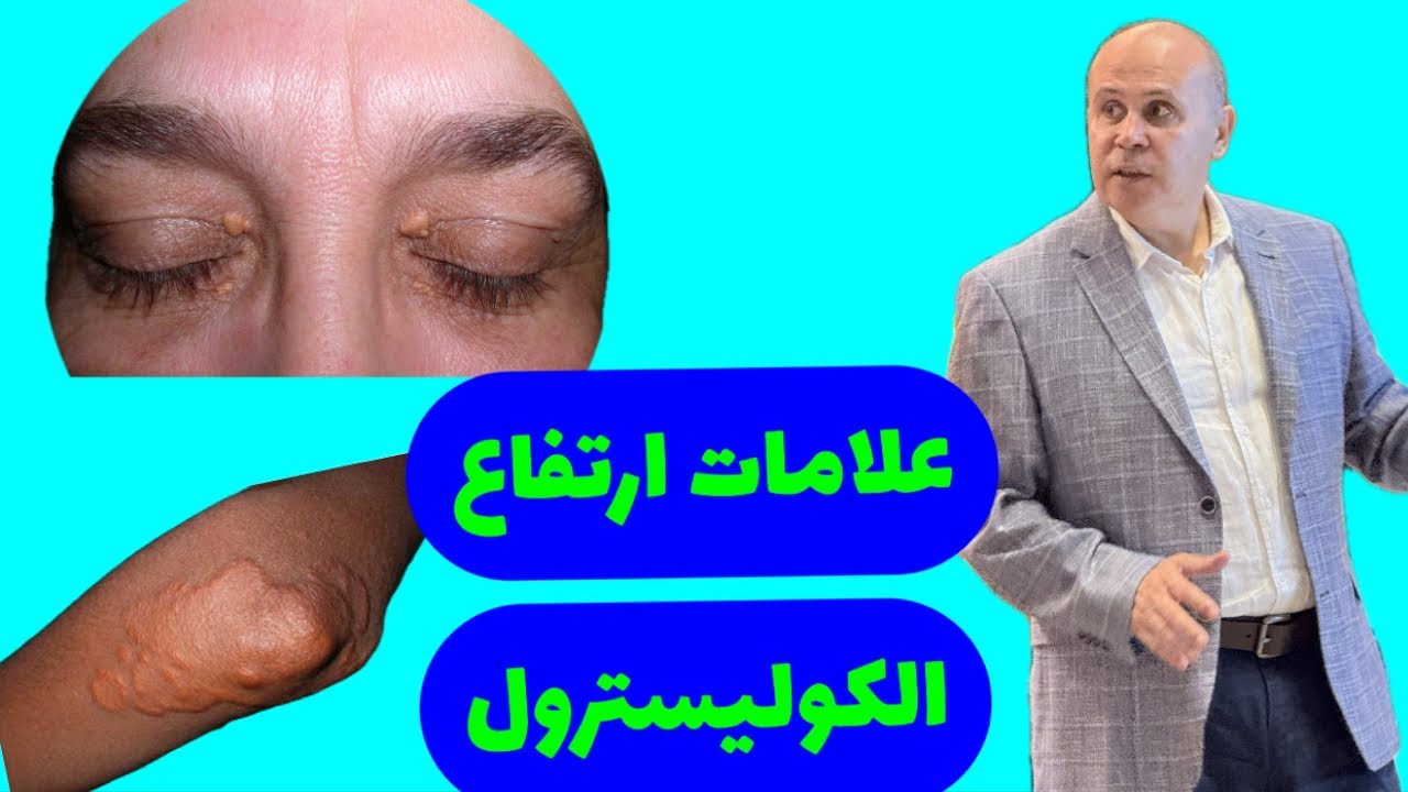 احــذر واحترس من علامات ارتفاع الكوليسترول في جسمك..وماهو المعدل الطبيعي