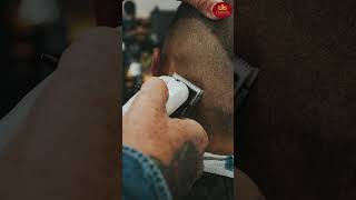 No-Shave Hair Transplant: Natural Results Without Anyone Knowing | Crown Hair Transplant |