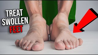 How To Treat Swollen Feet in 2024