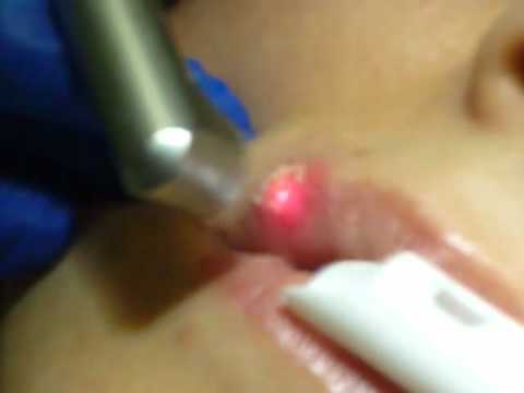 Image result for Laser Canker Sore Treatment