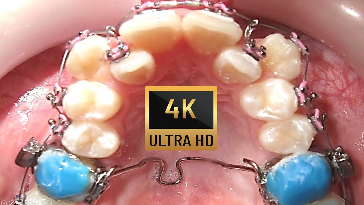 HOW #BRACES WORK JAW SURGERY #timelapse of Crossbite. #lifechanging #4k ...