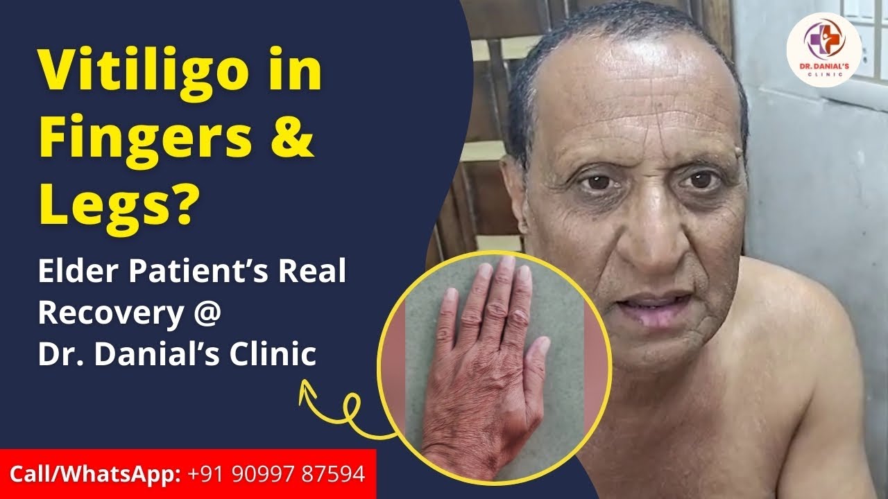 Vitiligo in Fingers & Legs? Elder Patient’s Real Recovery @ Dr. Danial’s 