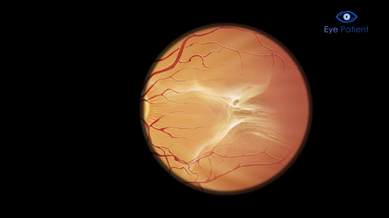 Retinal Angiography | Free Eye Patient App
