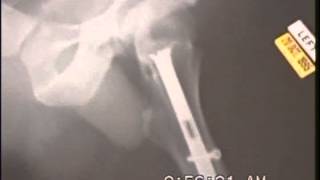 X Rays of Comminuted Compound Left Femur Fracture
