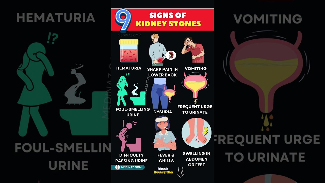 9 Signs Of Kidney Stones You Shouldn T Ignore How To Know If Have