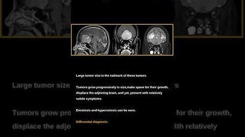 Olfactory groove meningioma#Meningioma#Extra-axial tumor.