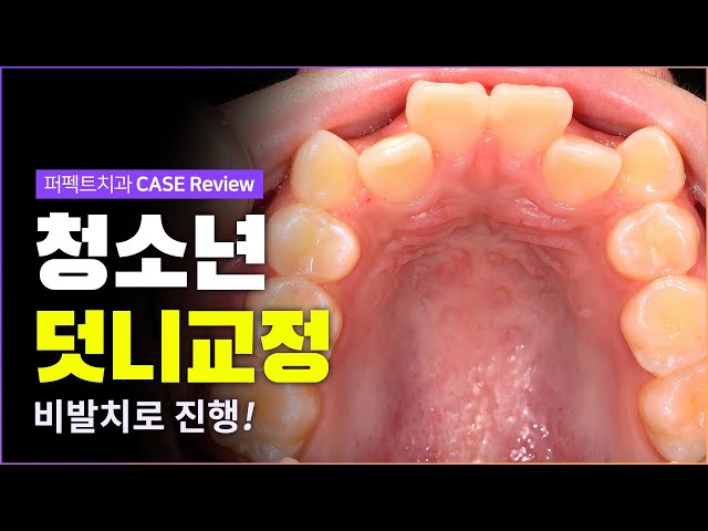 👦🧒청소년 덧니교정 | 비발치로 진행❗ (feat.악궁확장)
