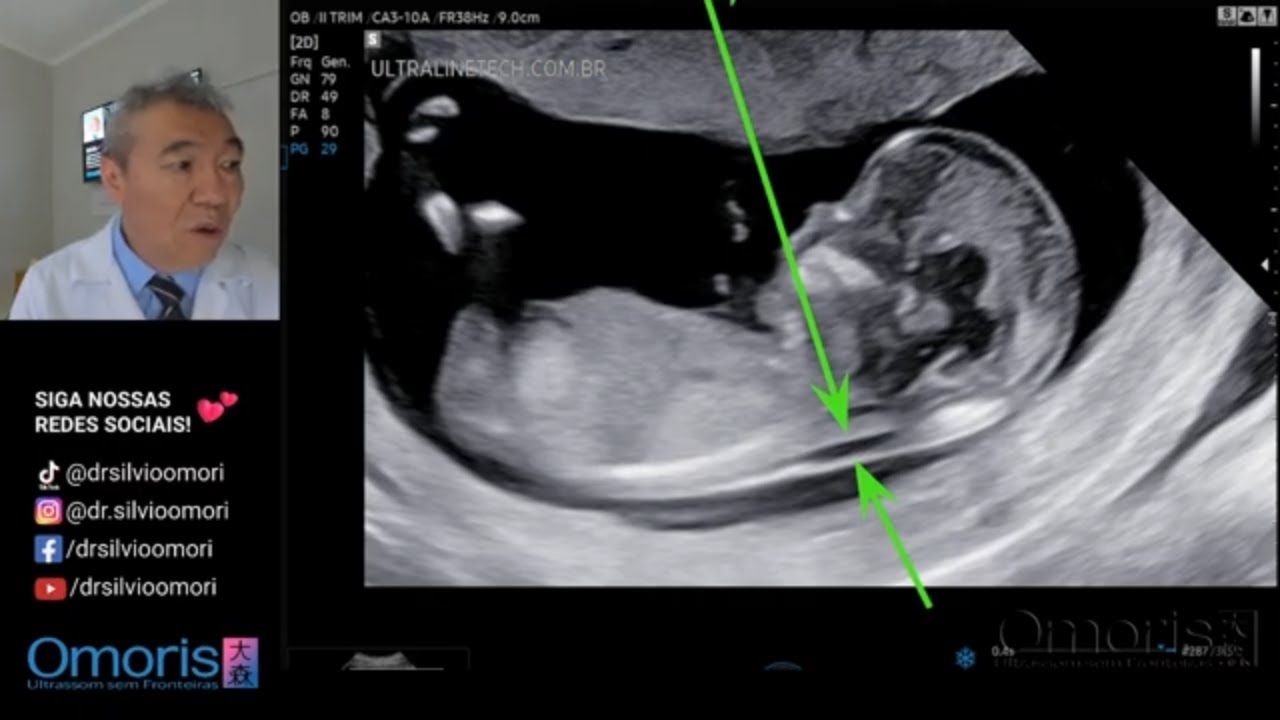 Translucência Nucal -12 SEMANAS