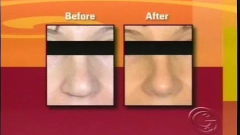 "Your Beautiful New Nose": Rhinoplasty by Dr. Jaso...