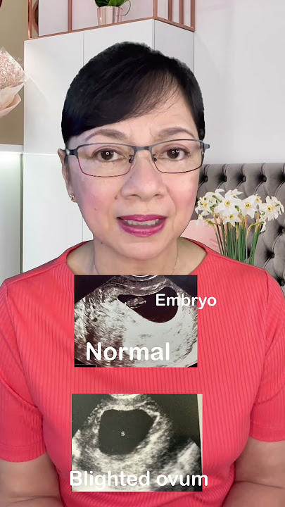Ano ang BLIGHTED OVUM?  Vlog 173