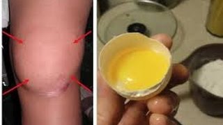 घुटनों में पानी ??? उत्तम इलाज़ सिर्फ 2 औष्दियों के जरिये – Water In Knee