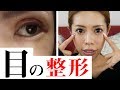 【整形】目の整形をしたので報告します。
