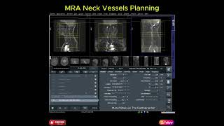 MRA NECK VESSELS PLANNING | SIEMENS SYNGO MR |