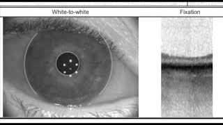 Biometry basics with the IOL master 700