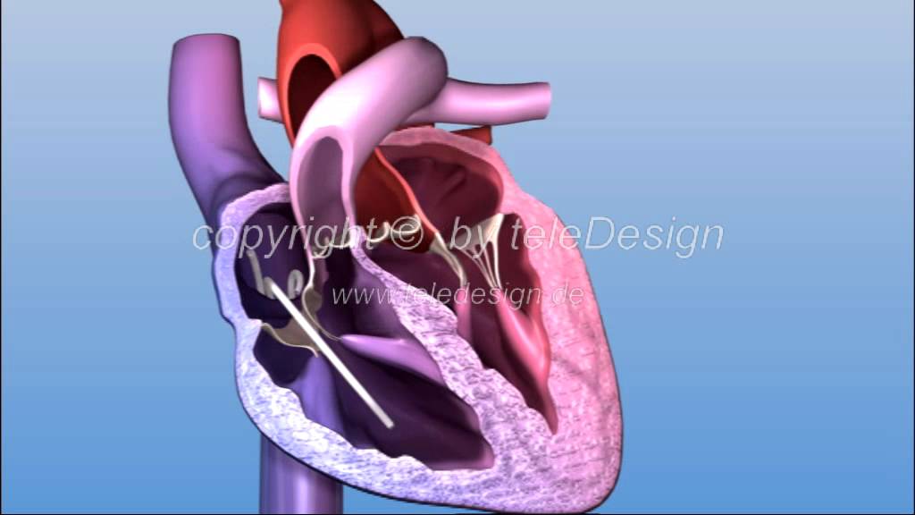 HGL 085 Ablation Herzrhythmusstörung PAL 169/ HGL 085 ablation PAL