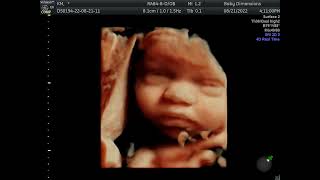 33 week Baby Extremely Hydrated IMG 20220824 1 3 VolCine