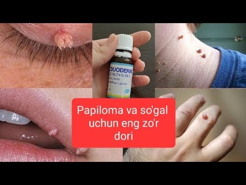 PAPILOMA, SO'GAL, MAZOL, KANDILOMA va KERATOMA uchun eng yaxshi dori vositasi