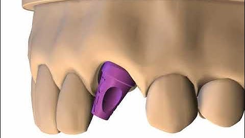 Instruction of Angled abutment A, B