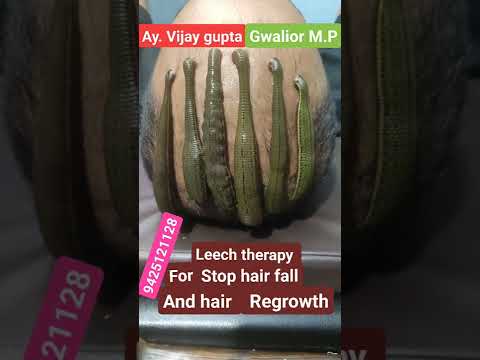 Leech therapy for hair problems