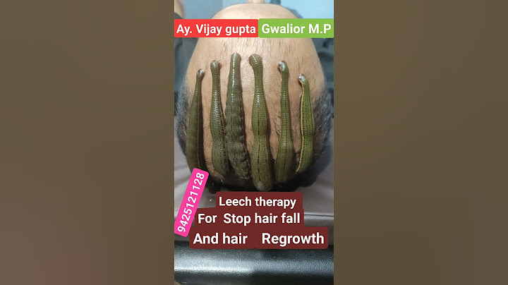 Leech therapy for hair problems