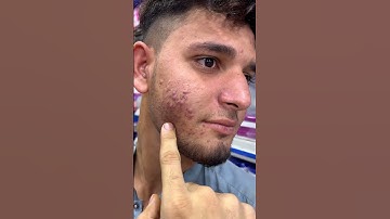 Glow & Clean Acne Serum & Tea Tree Face Wash Amazing #ameenbeautytips