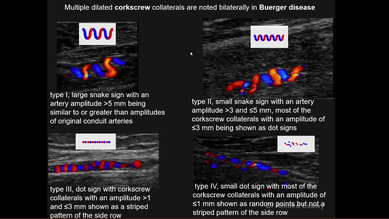 4 peripheral arterial triplex ultrasound vasculitis Dr Ahmed Esawy