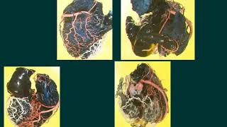 06 collateral circulation