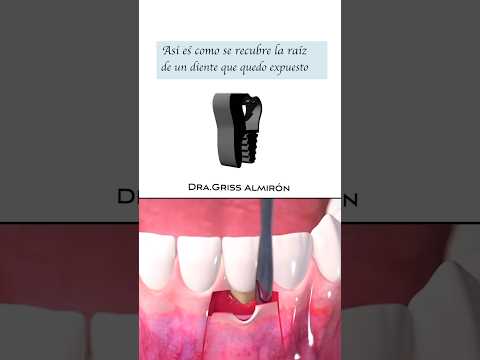 Gingivoplastia injerto de encía para raíces expuestas por recesión