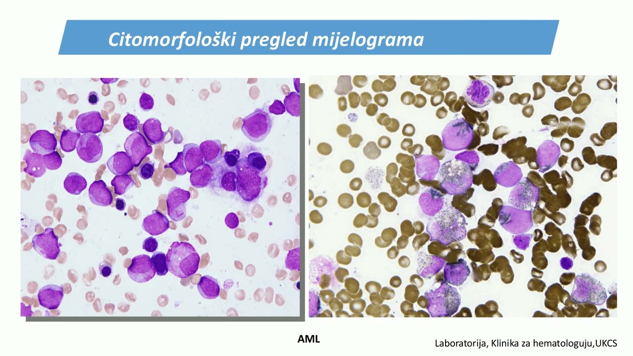 Akutne leukemije   AKUTNE LEUKEMIJE