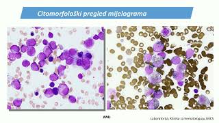 Akutne leukemije   AKUTNE LEUKEMIJE