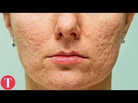  Things You Didn&#;t Know About ACNE