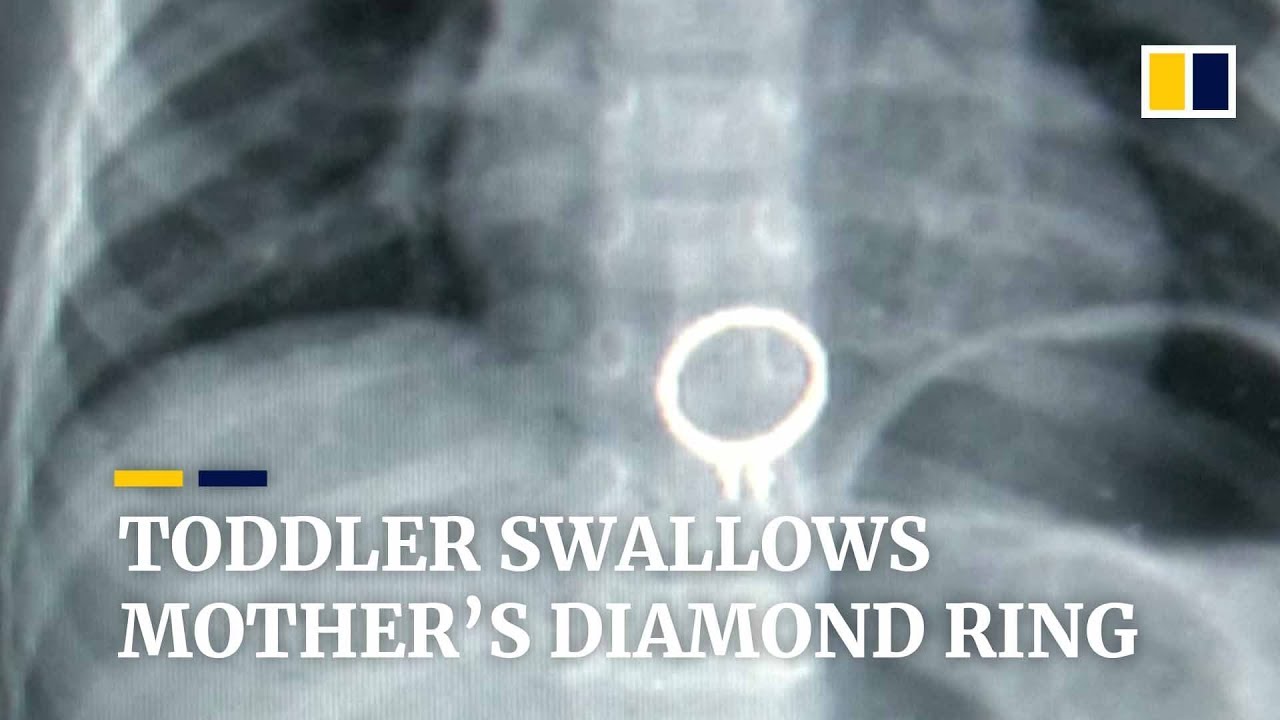 Three-year-old Chinese boy swallows mother’s diamond ring
