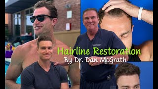 2 FUT Hair Transplant Hairline Lowering Results after 2 Years