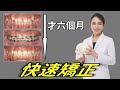 一年內完成的快速矯正，LH矯正、Fast Braces，可以改嘴凸和咬合不正嗎？｜林榆芩醫師