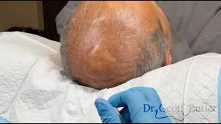 Removal of a galeal cyst/scar tissue