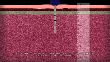 Ranfac Marrow Cellution Bone Marrow Aspiration - 3D Medical Animation