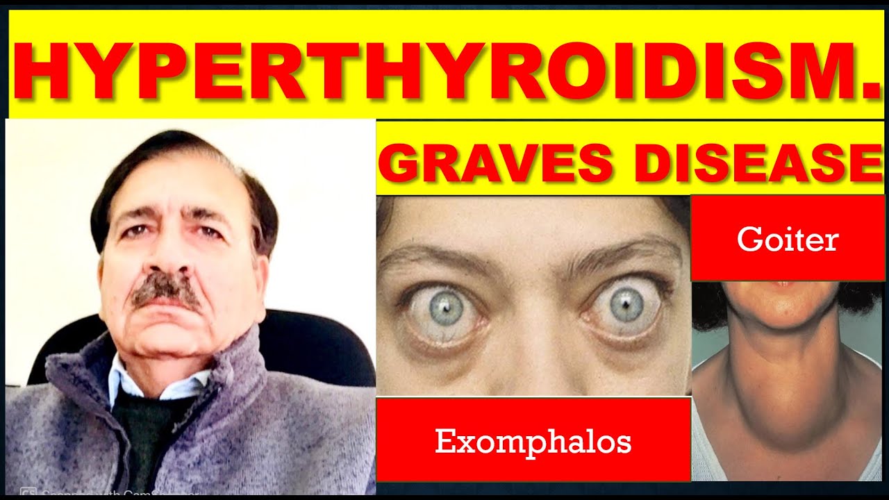 Graves disease hyperthyroidism. causes. symptoms. diagnosis and