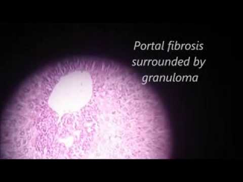 Bilharizial portal fibrosis (liver)